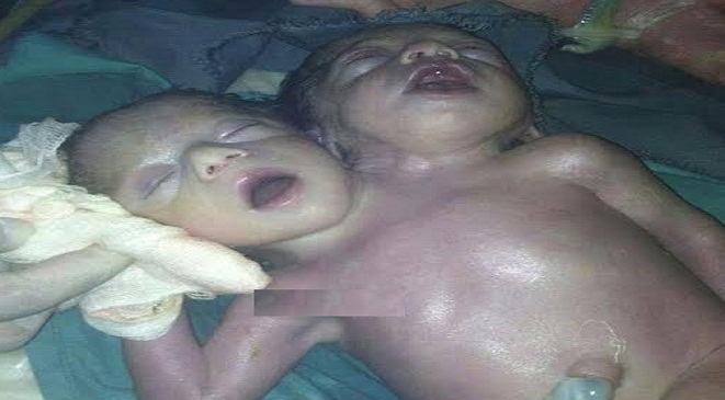 أم يمنية تلد طفل بـ«رأسين»‎ (صورة)