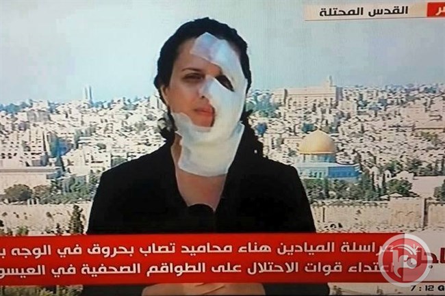 شاهد بالصور.. مذيعة تلفزيونية في بث مباشر بعد احتراق وجهها بنيران العدوان الإسرائيلي