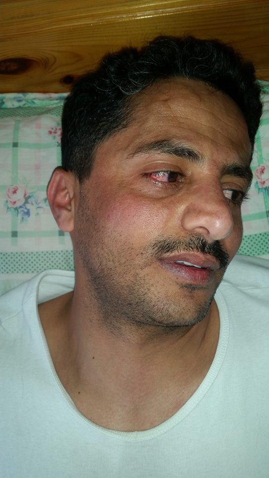 قيادي حوثي سابق يتعرض للضرب المبرح على أيدي مليشيا الجماعة (صور)