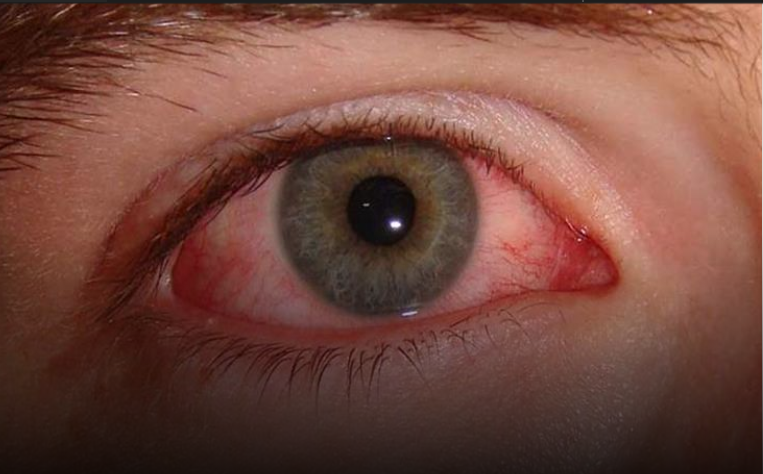 4 علامات تظهر على العين تؤكد الإصابة بكورونا