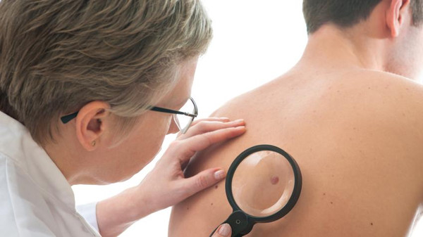 علاج جديد لأخطر أنواع سرطان الجلد