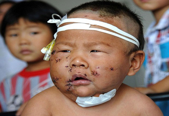 صورة للطفل الذي طعنته أمه بوجهه 99 طعنة بسبب عضه صدرها أثناء رضاعته
