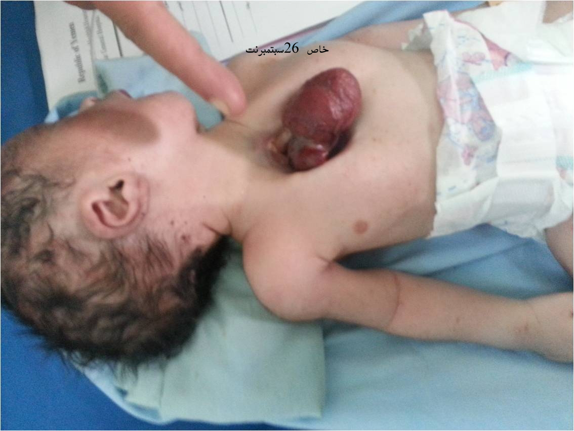 ولادة طفل بمستشفى ذمار و«قلبه» خارج قفصه الصدري ( صورة )