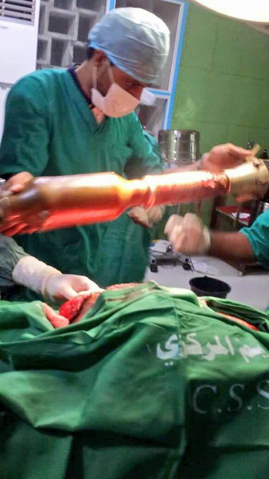 بالفيديو.. فريق طبي يمني ينجح في ‏إستخراج قذيفة من ساق جندي أصيب في المخا